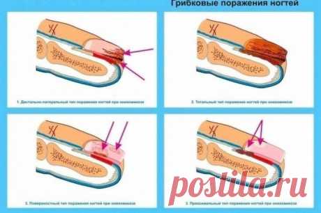 КАК ВЫЛЕЧИТЬ ГРИБОК НА НОГТЯХ