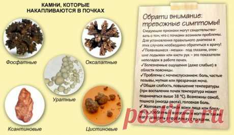 «Камни в Почках: Симптомы, Лечение у Женщин Причины образования камней в почках Камни в почках также различаются по своему составу. По этому признаку они подразделяются на: