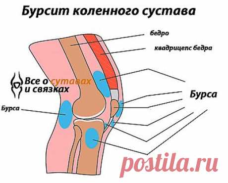 Бурсит коленного сустава: симптомы и лечение | ПолонСил.ру - социальная сеть здоровья