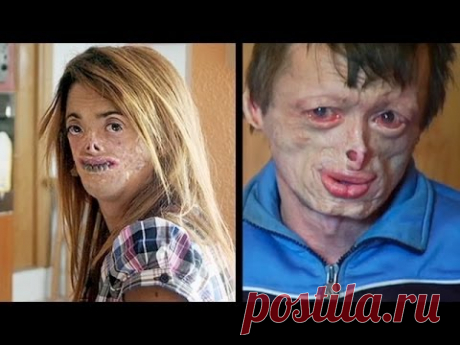 Болезнь сделала из меня мумию (полный выпуск) | Говорить Україна