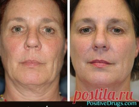 5 природных способов предотвращения провисания кожи - Советы на каждый день