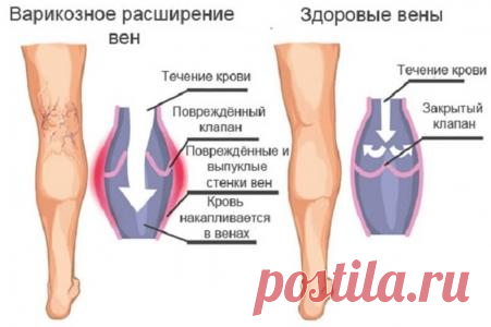 Чего боится варикоз: эффективные народные методы лечения