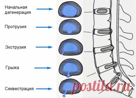 Грыжа межпозвонкового диска: лечить нельзя оперировать. | Невролог Татьяна Ершова | Дзен