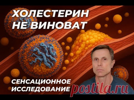 Сенсационное исследование : бляшки в сосудах не связаны с высоким холестерином. Революция в науке!