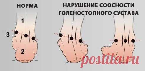 Интересные новости      КОМПЛЕКС УПРАЖНЕНИЙ ДЛЯ ЛЕЧЕНИЯ ПЛОСКОСТОПИЯ.
