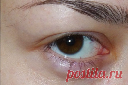 Как лечить ячмень на глазу дома: капли, мази, народные средства