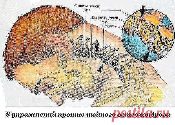 Первые проявления шейного остеохондроза — боли в спине, головные боли, головокружение, 