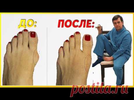 Как избавиться от ПЛОСКОСТОПИЯ? Как убрать КОСТОЧКИ НА НОГАХ в домашних условиях?