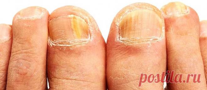 Всего два ингредиента помогут вам забыть о грибке ногтей!
