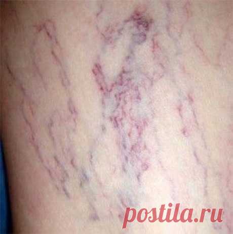 Лечение сосудистых звездочек народными средствами
