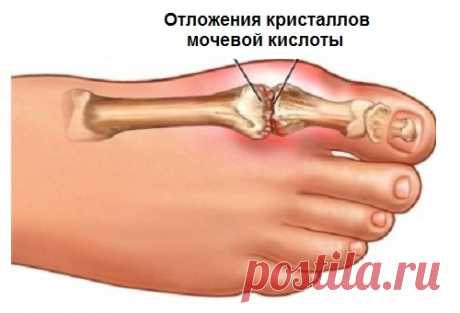 Вот, как можно избавиться от кристаллизации мочевой кислоты, чтобы предотвратить подагру и боли в суставах Полезная информация! Подагра — это состояние здоровья, более похожее на нарушение обмена веществ, вызванное чрезмерным накоплением мочевой кислоты в