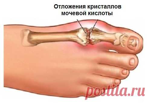 Вот, как можно избавиться от кристаллизации мочевой кислоты, чтобы предотвратить подагру и боли в суставах