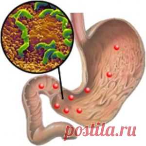 Хеликобактер пилори: чем опасна и как избавиться от этой бактерии? Схема лечения хеликобактериоза.