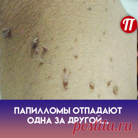 Настой хвои
Лучшим способом, как избавиться от
папилломавируса народными
средствами,является употребление
хвойного отвара. 1 ст. л.
измельченной хвои заливают 1 ст.
кипятка и варят в течение 20 минут.