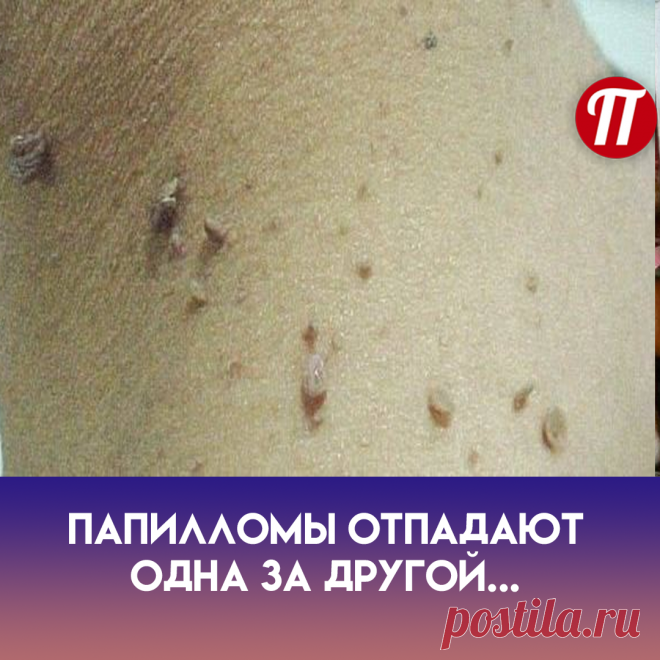 Настой хвои
Лучшим способом, как избавиться от
папилломавируса народными
средствами,является употребление
хвойного отвара. 1 ст. л.
измельченной хвои заливают 1 ст.
кипятка и варят в течение 20 минут.