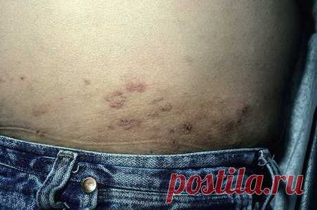 Дерматит Дюринга | Кухня Кухня Дерматит Дюринга — заболевание кожи, причина которого не выяснена. Заболевание характеризуется длительным течением с приступообразным появлением на коже туловища и конечностей зудящей сыпи в виде