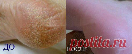 Пяточки как у младенца

Этот очень хороший рецепт поможет тем, у кого шершавые руки,трещины на пятках, натоптыши,ногти на ногах &quot;корявые&quot; и &quot;страшные&quot;. Ваши пятки порозовеют, ногти приобретут красивый и блестящий цвет. Так же можно смазывать локти рук. Смесь эта-дешевая, доступная, верная.
В общем-то их два рецепта с глицерином, но они оба &quot;работают&quot;. Берем...продолжение читать тут odnoklassniki.ru/togetherness
•••