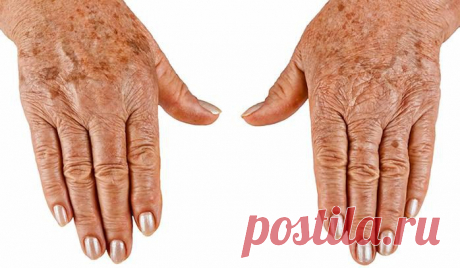 Возрастные пятна - причины и способы устранения » Женский Мир