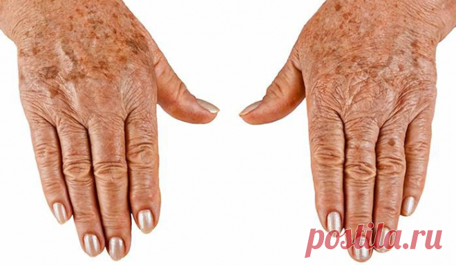 Возрастные пятна - причины и способы устранения » Женский Мир