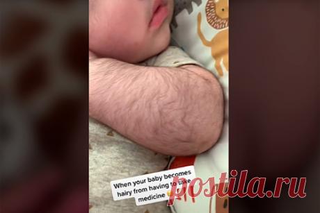 Мать показала ребенка с волосами по всему телу и прославилась в сети. Женщина показала новорожденного сына с волосами по всему телу и прославилась в сети. По словам Бри Шелби (Bri Shelby), ее ребенку диагностировали гиперинсулинизм. Чтобы поддерживать уровень сахара в крови, мальчик должен принимать препарат «Диазоксид». Побочным эффектом этого лекарства является рост волос на теле.