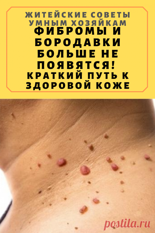 Фибромы и бородавки больше не появятся! Краткий путь к здоровой коже | Житейские Советы
