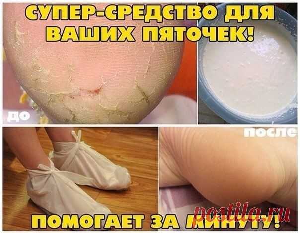 Супер-Средство для ваших пяточек! Помогает За минуту !