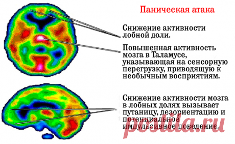 Панические атаки и беспокойство связаны с низким содержанием витамина B6 и уровнем железа! Такие важные витамины и микроэлементы! Согласно недавнему японскому исследованию, существует сильная связь между приступами паники/тревоги и уровнем