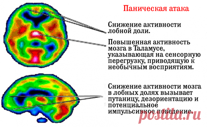 Панические атаки и беспокойство связаны с низким содержанием витамина B6 и уровнем железа! Такие важные витамины и микроэлементы! Согласно недавнему японскому исследованию, существует сильная связь между приступами паники/тревоги и уровнем
