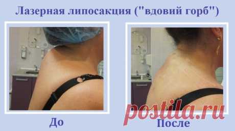 Доктор Бубновский. Как убрать вдовий горб