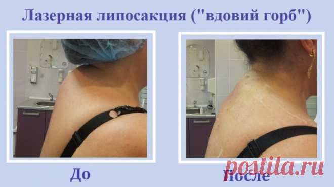 Доктор Бубновский. Как убрать вдовий горб