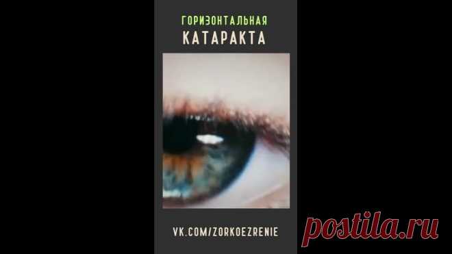 Что такое Горизонтальная катаракта: Горизонтальная катаракта — это заболевание, при котором хрусталик глаза становится мутным. Он становится непрозрачным, из-за чего человек плохо видит. При этом, у пациентов, страдающих такой катарактой, зрение может быть хорошим. Это зависит от формы заболевания. Так, люди с горизонтальной катарактой могут плохо видеть только на близком расстоянии, но при этом им
Показать ещё