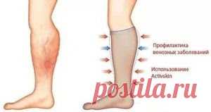 Тромбоз вен нижних конечностей – причины, симптомы, профилактика