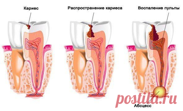 ПРОФИЛАКТИКА КАРИЕСА – КАК ОСТАНОВИТЬ И ПРЕДОТВРАТИТЬ КАРИЕС ЗУБОВ.