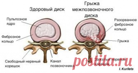 Грыжа диска: вместо операции попробуй это решение!