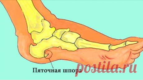 Пяточных шпор больше не будет! Эти 3 простых способа и 3 упражнения невероятно быстро избавят от боли в пятках! — Полезные советы