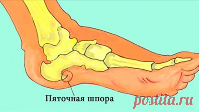 Пяточных шпор больше не будет! Эти 3 простых способа и 3 упражнения невероятно быстро избавят от боли в пятках! — Полезные советы
