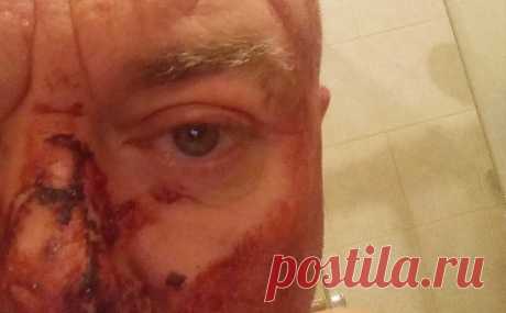 Журналист Павел Лобков сообщил об избиении в центре Москвы. Лобков рассказал, что нападение произошло на Патриарших прудах. На фото он показал окровавленные лицо и руку. В 2016-м на журналиста уже нападали, тогда это было ограбление