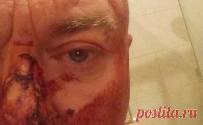 Журналист Павел Лобков сообщил об избиении в центре Москвы. Лобков рассказал, что нападение произошло на Патриарших прудах. На фото он показал окровавленные лицо и руку. В 2016-м на журналиста уже нападали, тогда это было ограбление