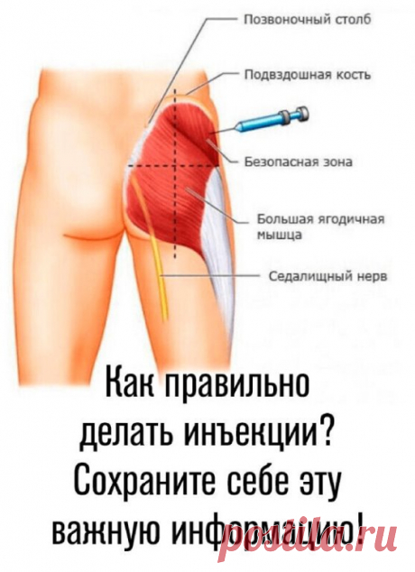 Такие уколы рекомендуется делать в наиболее крупные мышцы в местах, отдаленных от основных кровеносных сосудов и нервов.

Как правило, для инъекции в ягодицу используют 3 или 5 кубовые шприцы. После проведения укола внутри мышечной ткани образуется депо, из которого препарат, благодаря разветвленной системе сосудов, попадает в кровь и разносится по организму.



Именно в ягодичных мышцах у человека находится наиболее мощный слой мышечной ткани, которая имеет мало нервных о...