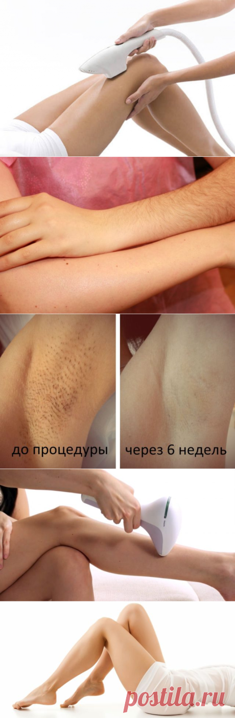 Фотоэпиляция: отзывы, фото до и после