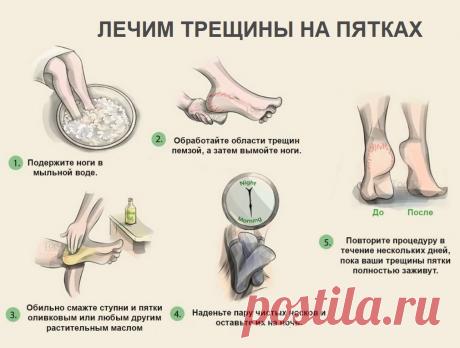 Лечение трещин на пятках