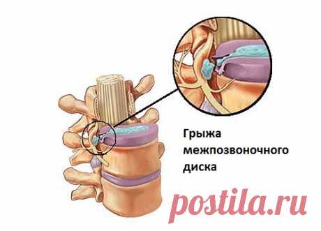 Симптомы межпозвоночной грыжи - Важное