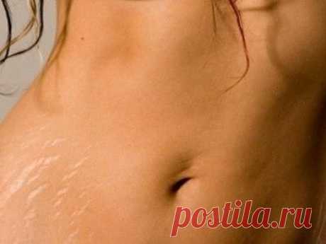 Лечим шрамы и растяжки растениями