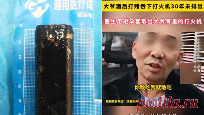 Врачи достали из желудка мужчины зажигалку, которую он проглотил 30 лет назад. Местные СМИ сообщают, что 67-летний мужчина по фамилии Дэн пришел в больницу с жалобами на сильное вздутие живота и боли, которые усиливались до такой степени, что он не мог лежать. Месяц он пытался лечиться самостоятельно, списывая ...