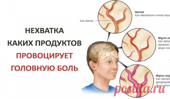 Нехватка каких продуктов провоцирует головную боль | Naget.Ru