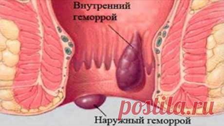 Она больше не боится ГЕМОРРОЯ! Смотри, 10 самых эффективных средств от свай.