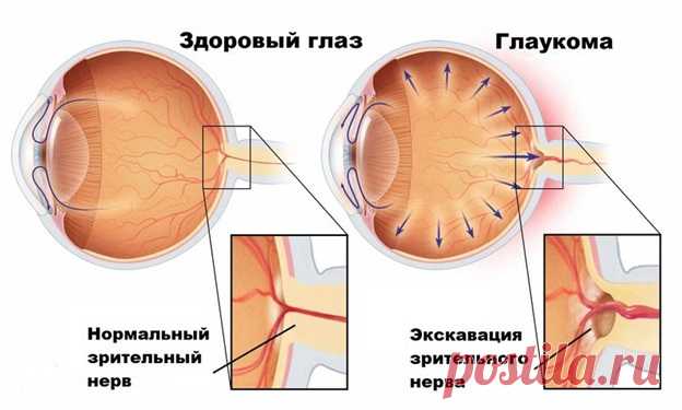 Глаукома – не слышали о ней? Знакомьтесь – серийный тихий убийца зрения