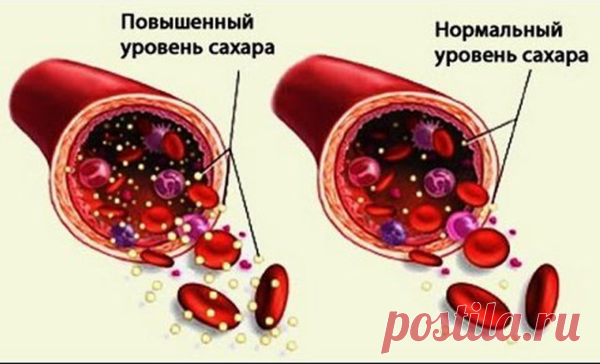 5 ранних признаков высокого сахара в крови (и как его реверсировать) | будь здоров! | Яндекс Дзен