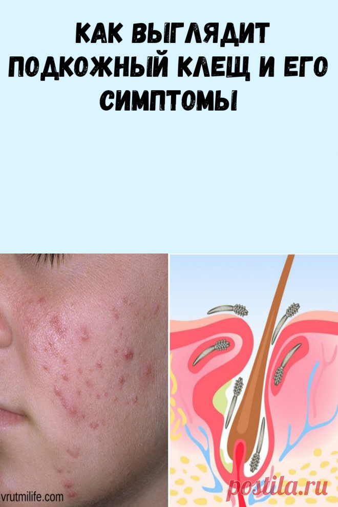 Как выглядит подкожный клещ и его симптомы