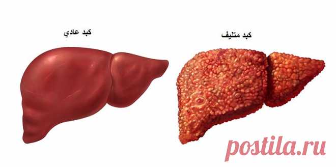 Цирроз печени - народное лечение | Советы Народной Мудрости
